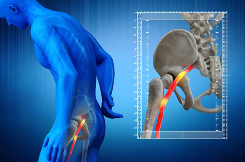 illustration showing the sciatic nerve and how nerve irritation can cause sciatic pain
