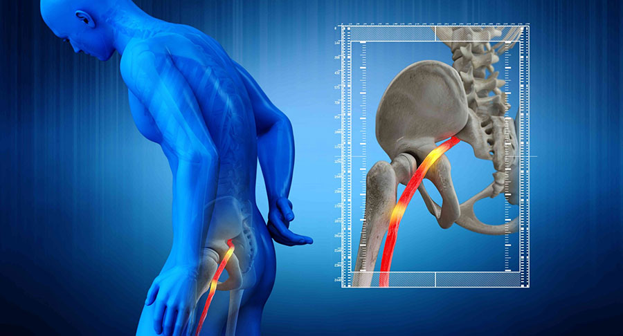 illustration showing the sciatic nerve and how nerve irritation can cause sciatic pain