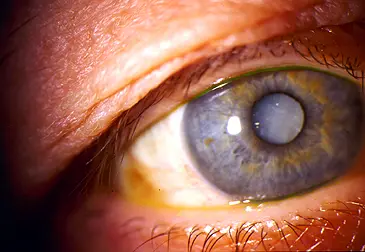 Cataract treatment concept showing cloudy eye lens affected by cataract